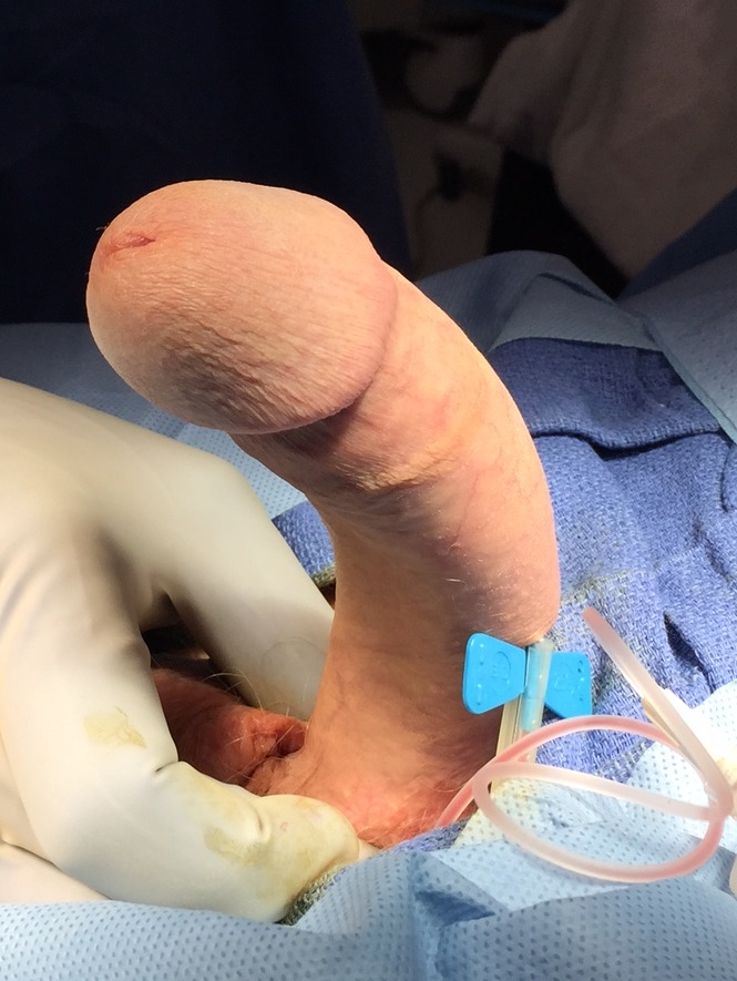 Surgery for curved penis
